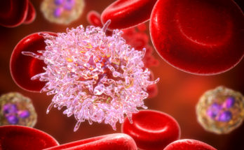 Este 28 de mayo se conmemora el Día Mundial del Cáncer de la Sangre: pacientes y especialistas buscan visibilizarlo