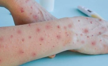 Se confirmó el quinto caso de viruela del mono en Uruguay; hay dos casos activos