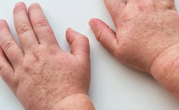 Las recomendaciones del MSP ante aumento de casos de infección por la bacteria Streptococcus