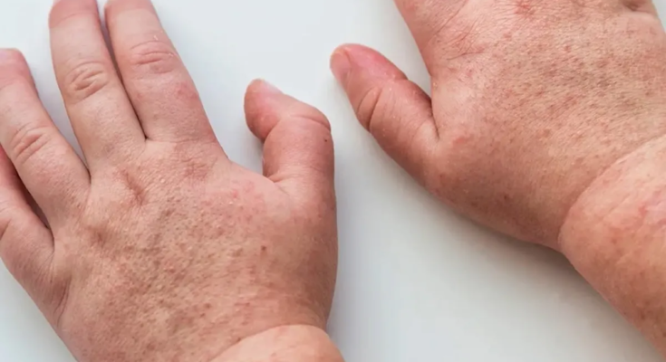 Las recomendaciones del MSP ante aumento de casos de infección por la bacteria Streptococcus