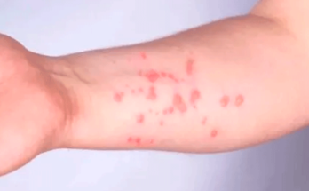 Recomendaciones prevención faringitis estreptocócica y escarlatina