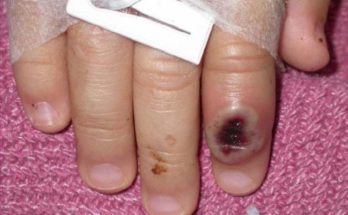 En Argentina, aislaron a un buque en el Río Paraná por un posible caso de viruela del mono en la tripulación