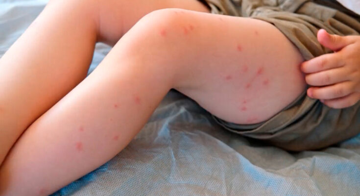 Se detectó un nuevo caso de sarampión en Montevideo